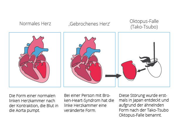 Herz mit Broken-Heart-Syndrom