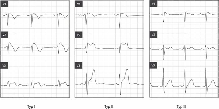 Das Brugada-Syndrom: Verlässlich nur per EKG diagnostizierbar